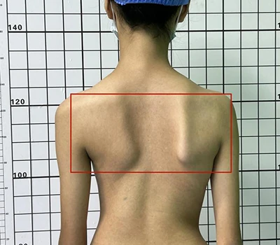 Avaluació integral de l'escoliosi: entendre, identificar i abordar la salut de la columna vertebral