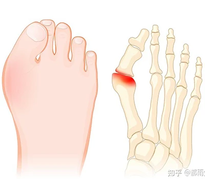 Hallux Valgus: una guia completa de la ciència