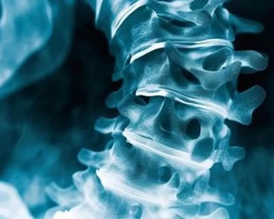 Detecció d'escoliosi amb IA i seguiment de l'alineació de la columna vertebral: una solució de de...