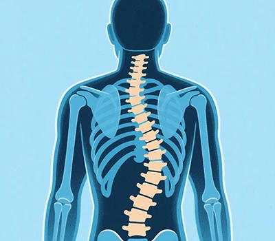 Escoliosi: Xianku 3D Scanner Body, 3D+AI, prevenció i correcció de l'escoliosi