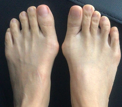 Mesura de Hallux Valgus: per què els escàners 3D estan superant els metges i els hospitals