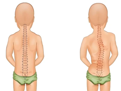 Nou mètode de detecció d'escoliosi: IA i columna vertebral digital 3D
